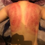 刮痧反傷身？