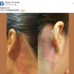 耳背刮痧促進全身循環 – Kathy Tam