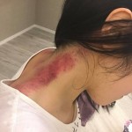 毒素積聚要刮痧 – Wing